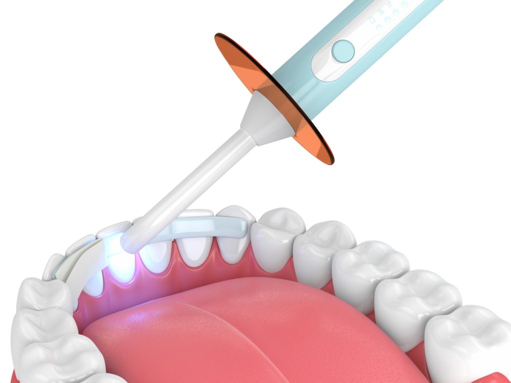 Illustration of a mouth showing teeth, gums, and tongue with a dental bonding tool