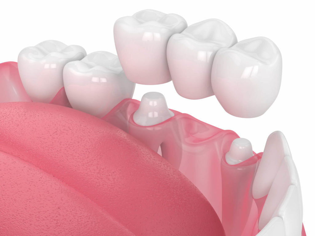 Illustration of a bottom row of teeth with a dental bridge being attached