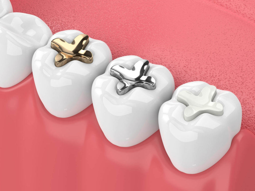 Illustration of a bottom row of teeth with different fillings applied