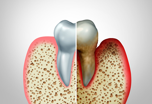 illustration of periodontal disease affecting a tooth